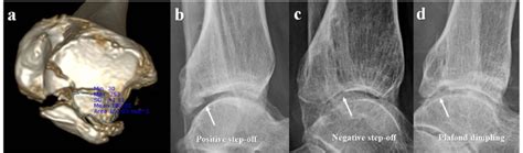 Post Operative Radiographic Measurements The Incarcerated Fragment