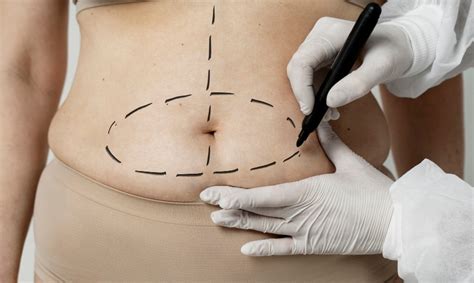 Cosmetic Surgery Glossary