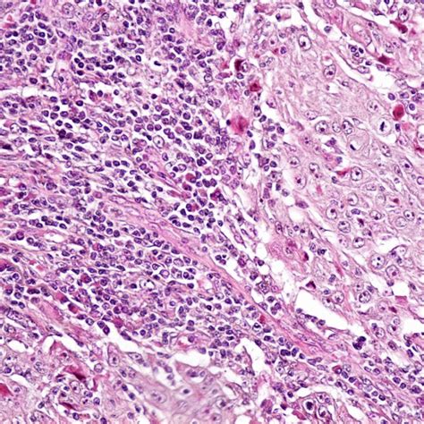 Moderately Differentiated Squamous Cell Carcinoma He Staining