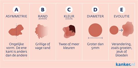 Huidkanker Herkennen De Rol Van Schoonheidsspecialisten Esth