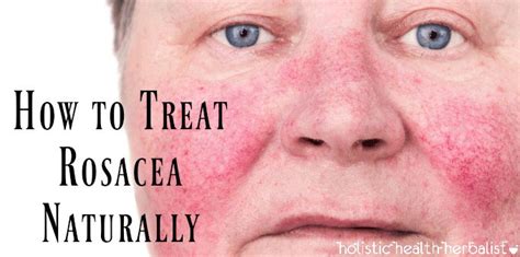 How To Treat Rosacea Naturally For Good Holistic Health Herbalist