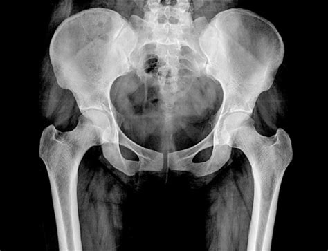 Hip Bursitis Iliopsoas