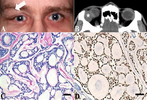 Adenoid Cystic Carcinoma Histology