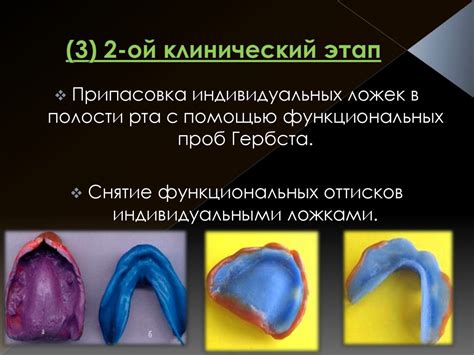 Полные съёмные пластиночные протезы (ПСПП) - презентация онлайн