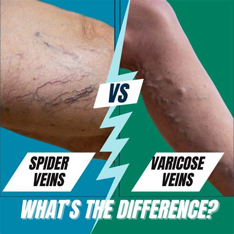 Varicose Veins Vs Spider Veins Blue Rock Medical