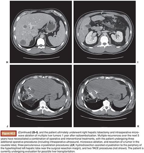 Neuroendocrine Tumors Radiology Key