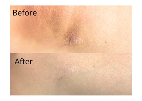 Clinical Resolution Lab Scar Repair Microneedling Before And After