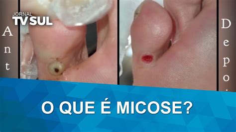 O que é micose causas sintomas prevenção e tratamentos YouTube