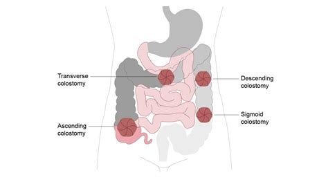 What Is A Stoma Stoma Function And Types Explained