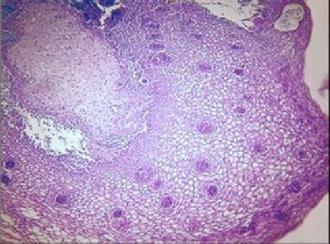 Condyloma Acuminata He Stain Ob 100 Download Scientific Diagram