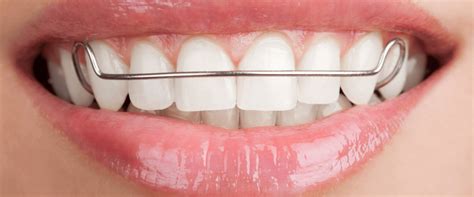 Maintaining Your Perfect Smile After Invisalign Treatment