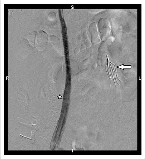 Fluoroscopic Image Showing Bard Eclipse Ivc Filter Placed In The