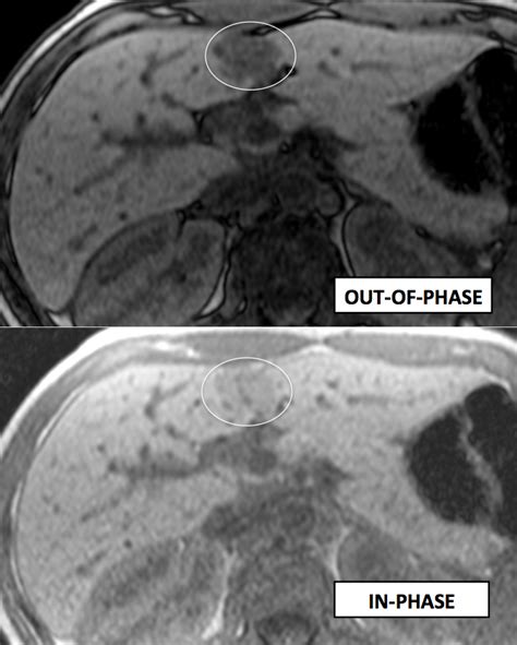 6 4 3 Hypermetabolic Geographic Focal Fatty Infiltration Of The Liver