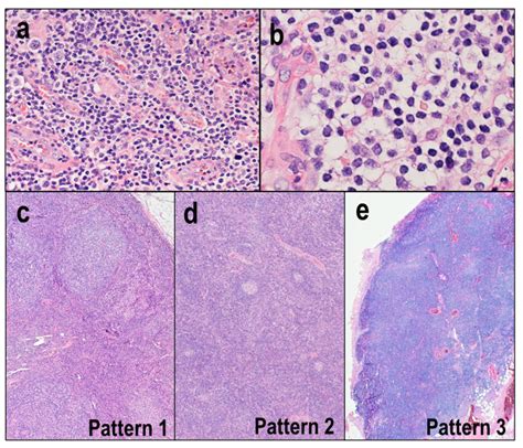 Diagnostics Free Full Text Pathological And Molecular Features Of Nodal Peripheral T Cell