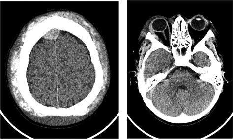 Spontaneous Epidural Hematoma In A Patient With Sickle Cell Anemia