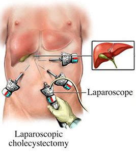 Gallbladder Removal Laparoscopic