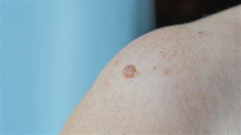 What It Means When You Have A Mole On Your Shoulder