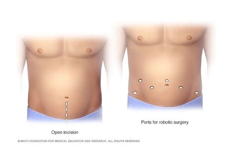 Prostate Cancer Treatment Feifer Urology