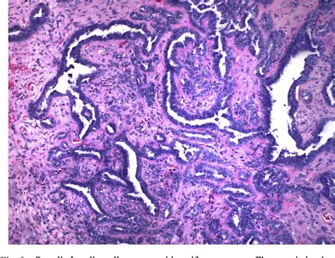 Figure 1 From Ovarian Sex Cord Stromal Tumours And Their Mimics