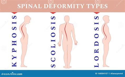 Diseases Of The Spine Scoliosis Lordosis Kyphosis Body Posture