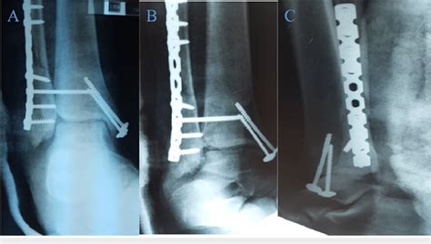 Post Operative Radiographs Ap Mortise And Lateral Views A Ap View