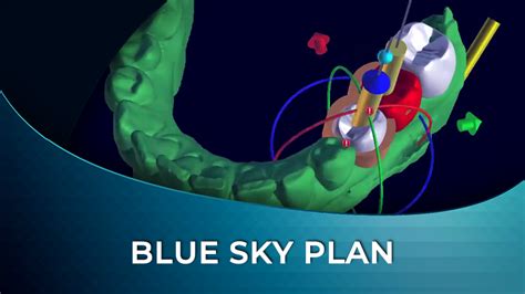 Blue Sky Plan Implant Treatment Planning And Temporary Restoration