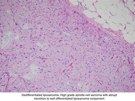 Pathology Outlines Liposarcoma