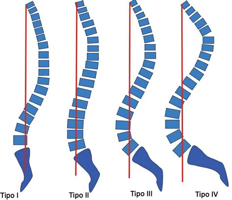 SciELO Brasil Sagittal Alignment Concepts And Spinopelvic