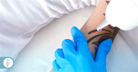 C Mo Funciona La Eliminaci N De Tatuajes Con L Ser Medicina Est Tica