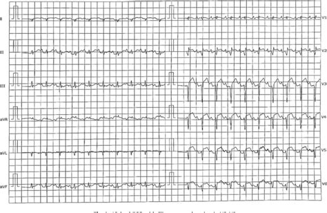 Infective Endocarditis With Perivalvular Abscess Complicated By Septic Embolization With Acute