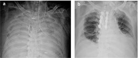 Portable Chest X Ray Findings On Days 2 And 25 Post Trauma A