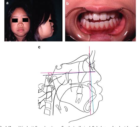 Figure 8 From How To Revise And Utilise The Cephalogram For