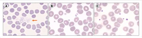 Figure 1 From Pseudo Gray Platelet Syndrome The First Case Report In