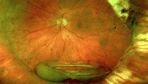 Retained Lens Fragments Dislocated Intraocular Lenses And Sutured