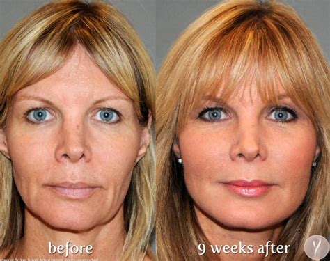 Mini Face Lift Michigan All About The Mini Face Lift Skin And Vein