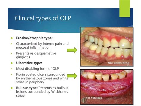 Oral Mucosal Lesions Ppt