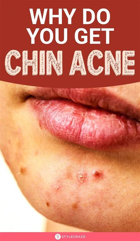 Chin Acne Pimples Causes Treatment And Skin Care Tips Artofit