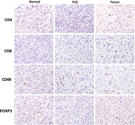 Immune Cell Infiltration In Human Tissues Days After Fus Treatment