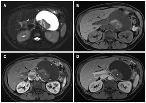 Walled Off Pancreatic Necrosis