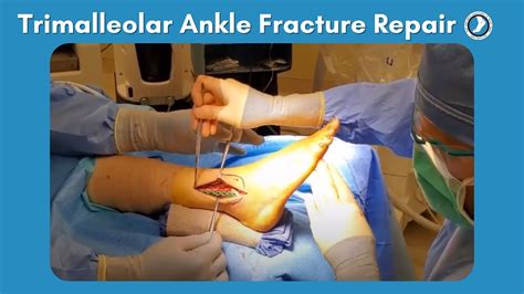 Trimalleolar Ankle Fracture Repair Youtube