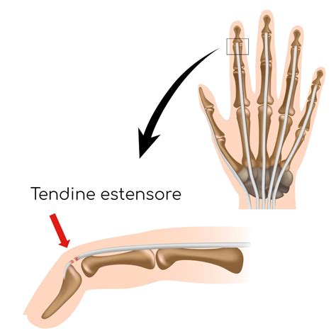 Normalizzazione Midollo acidità lesione tendine mignolo mano Extra