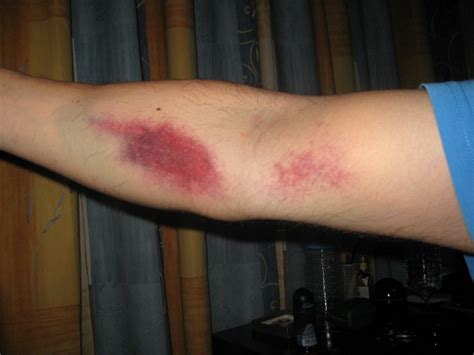 Bruising After Blood Test: Causes and Dealing Methods | Healthcare-Online