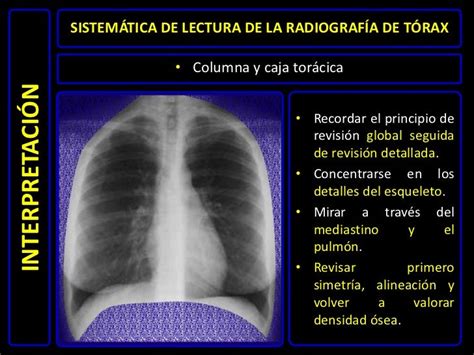 Diagnóstico Por Imágenes Radiografía De Tórax Normal