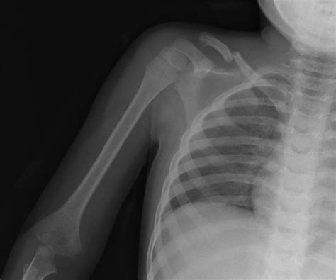 Clavicle Fracture - Orthopedics - Medbullets Step 2/3