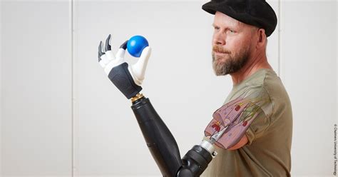 Bionic Hand Surgical Engineering Innovations Enable Full Control