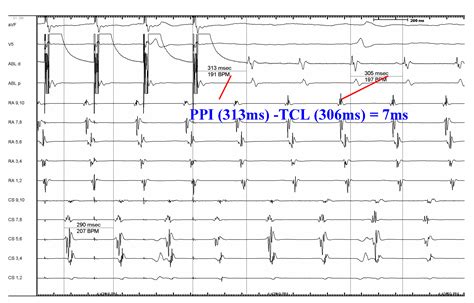 Atrial Flutter — Diagnosis, Management and Treatment | IntechOpen