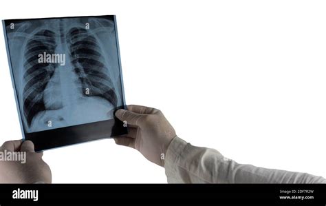 X-ray of the human lungs isolated on white, the doctor examines the human lungs in the picture ...