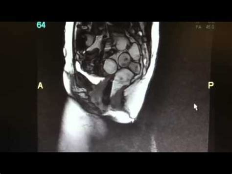 Defecogram or Proctogram of Rectocele - YouTube