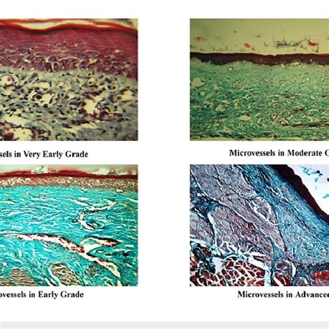 Assessment Of Microvessels In Different Grades Of Osmf In Masson S