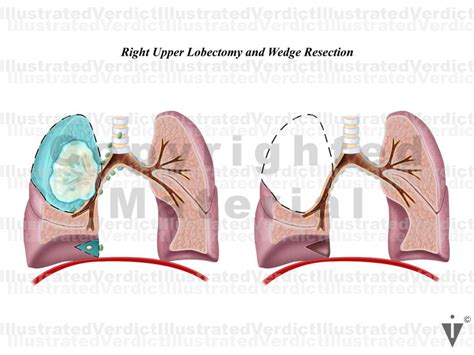 Right Upper Lobectomy Technique